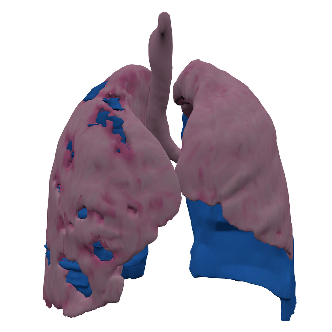 Covid Lung Model